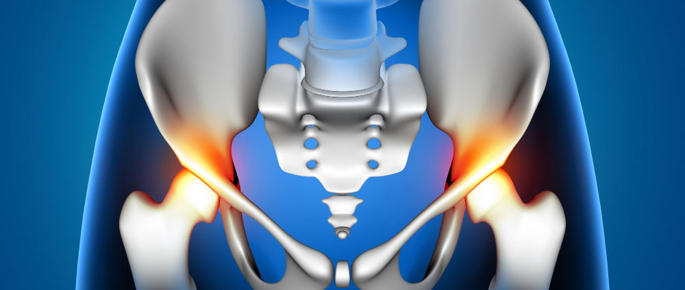 Quanto dura la degenza di riabilitazione dopo una protesi all'anca